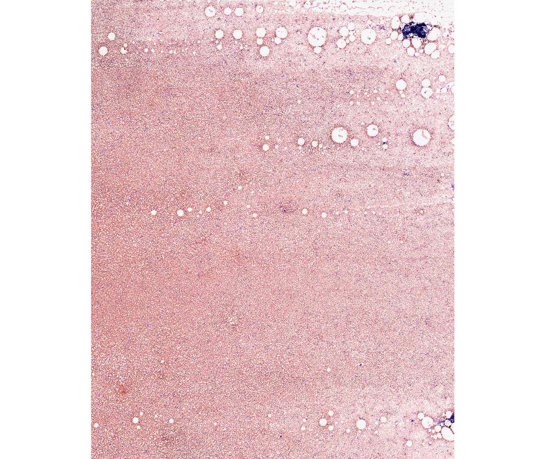 #82, Human Bone Marrow Smear (Wright's stain) 